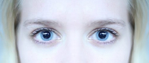 Eye Pupils Dilated